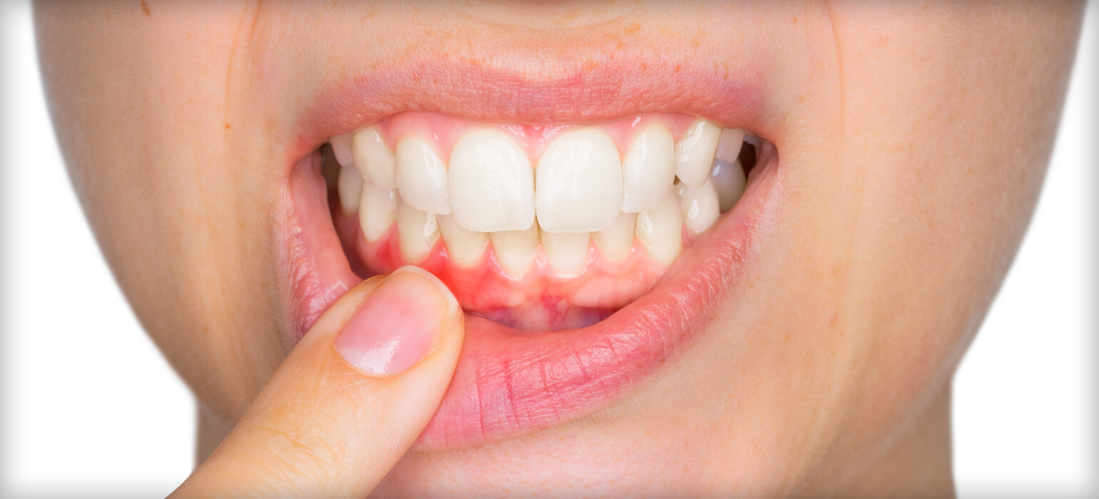 The Four Stages of Gum Disease