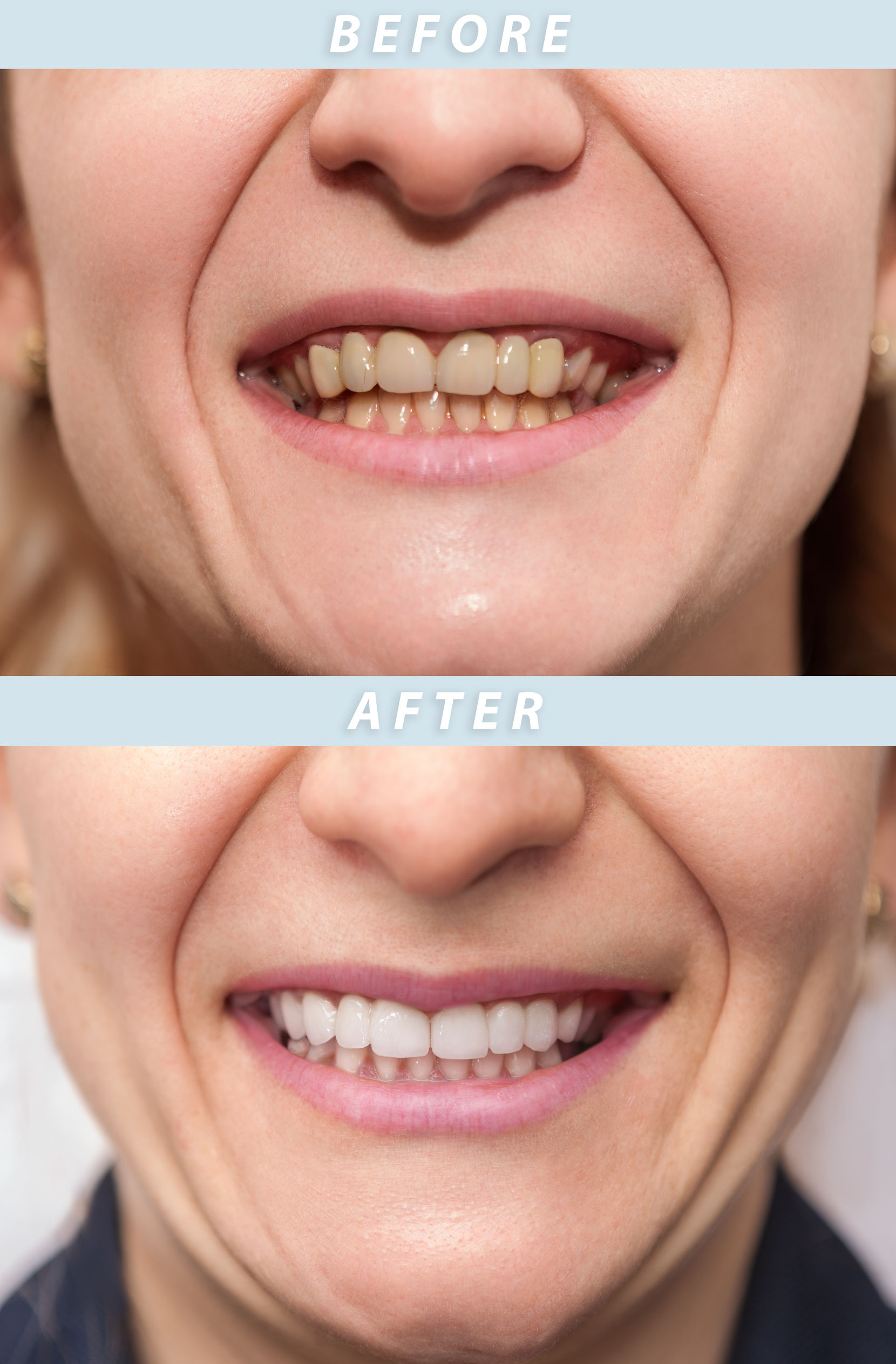 How to Tell if You Qualify for Veneers
